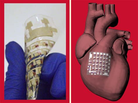 Implantable Device Can Monitor And Treat Heart Disease University Of