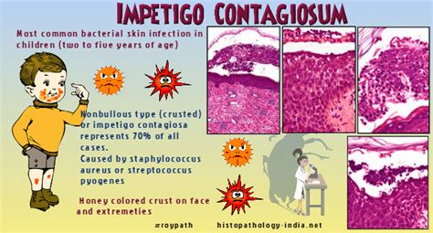 Pathology Of Impetigo Dr Sampurna Roy Md