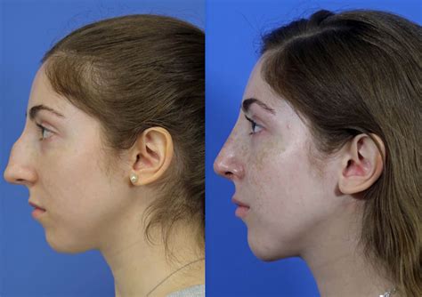 Rhinoplasty Nose Job Before And After Photos Savannah Facial Plastic