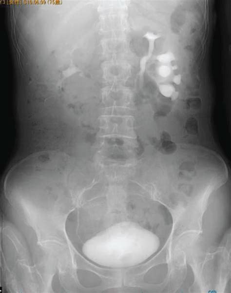 Ivp Shows Hydronephrosis Of The Left Lower Pole In The Incomplete