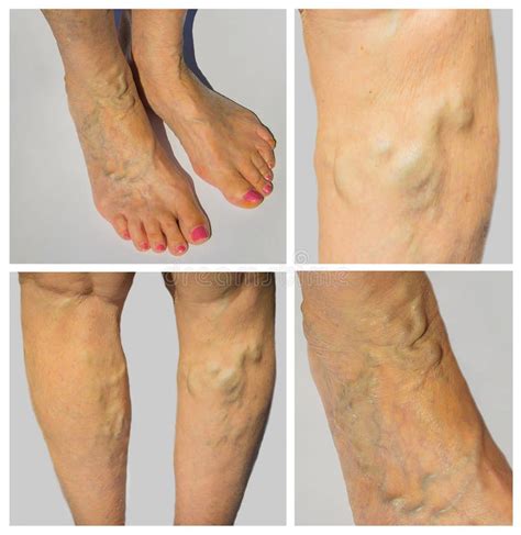 Varicose Veins On A Female Legs Stock Image Image Of Edema Adult