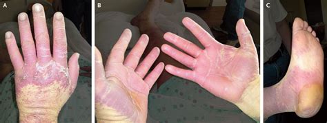 Palmarplantar Rash With Cytarabine Therapy Nejm