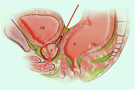 Robot Assisted Radical Prostatectomy Urohealth Clinic