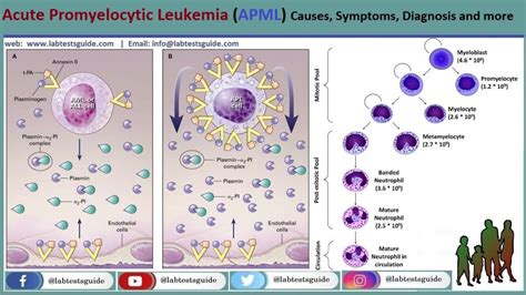 Acute Promyelocytic Leukemia Apml Symptoms Diagnosis And More Lab