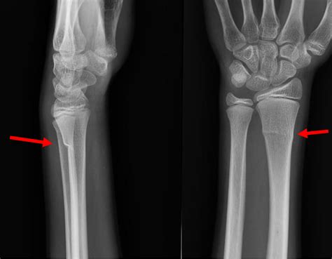 Distal End Radius Fracture X Ray Broken Wrist Treatment In Raleigh Nc John Erickson Md