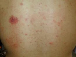 Suggest otc oral meds please? answered by dr. 10 Ways to Cure Prickly Heat Rash with Natural Home Remedies