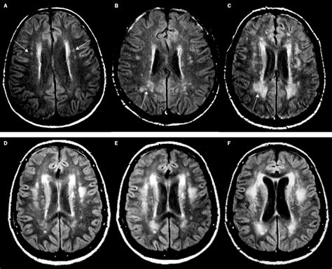 Progression Of Cerebral White Matter Lesions 6 Year Results Of The