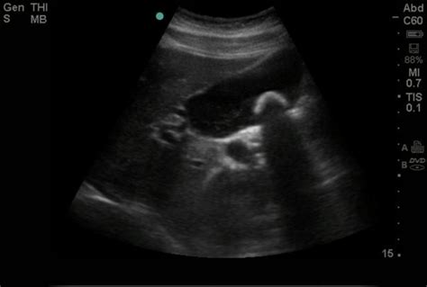 Figure Gallstone On Point Of Care Ultrasound Contributed By Emory