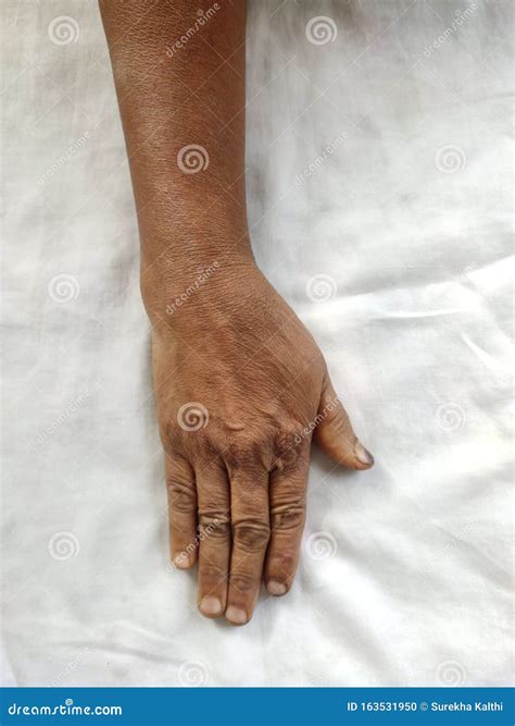 Dislocated Hand After Wrist Fracture Stock Photo Image Of Orthopedic White