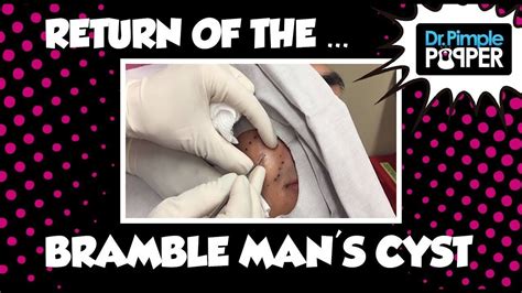 Return Of The Cyst With Bramble Man Youtube Cysts Pimples