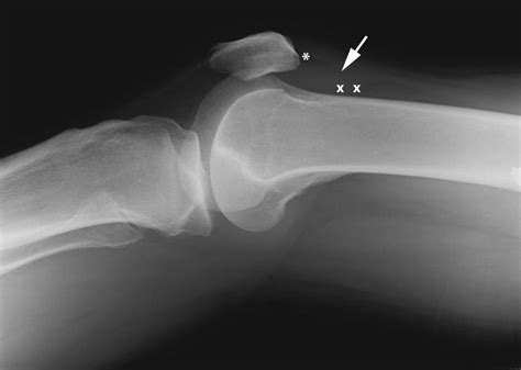 Lateral Radiograph Showing An Effusion In The Suprapatellar Pouch