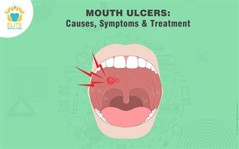 Mouth Ulcers Elite Dental Care