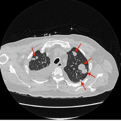 Ct Scan Of The Chest With Contrast Showing Multifocal Infiltrates