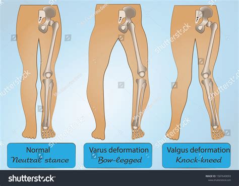 Vektor Stok Medical Poster Normal Legs Varus Valgus Tanpa Royalti Shutterstock