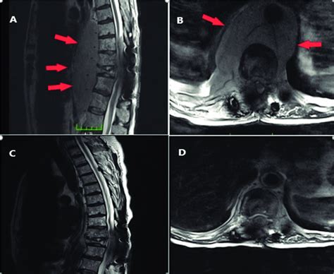 Magnetic Resonance Imaging Showing Lytic Lesions Involving All Spinal