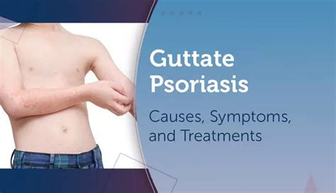 Guttate Psoriasis Causes Symptoms And Treatments Mypsoriasisteam