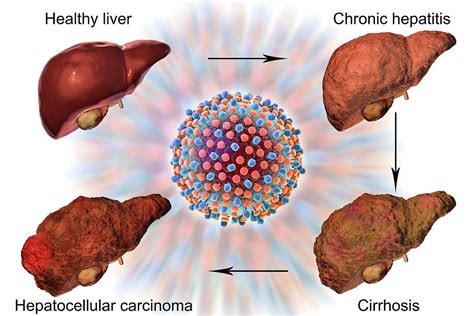Stages Of Liver Disease In Hepatitis C Photograph By Kateryna Kon