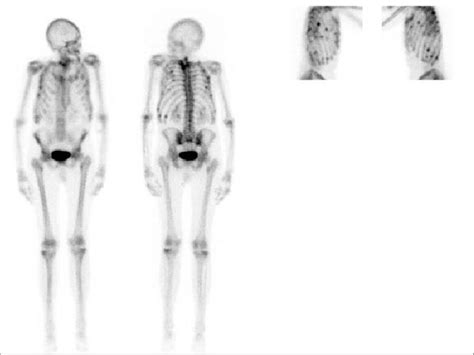 Bone Scintigraphy With Multiple Fractures Download Scientific Diagram