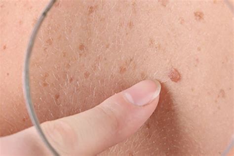 Skin Spots Specialist Dermatologists
