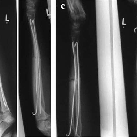 Clinical Case Example Of A Patient With A Fracture Nonunion Of The Ulna