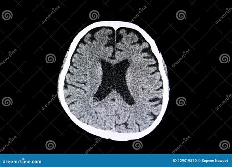 Brain Atrophy Stock Photo Image Of Cerebral Hypertension 129019570