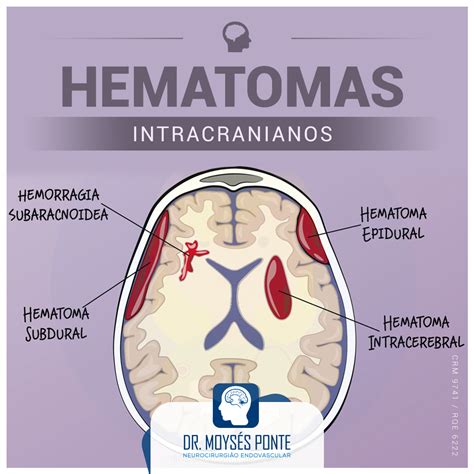 Hematomas Intracranianos Dr Moys S Ponte
