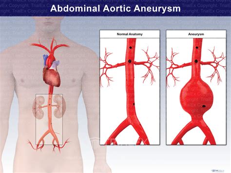 Abdominal Aortic Aneurysm Trialexhibits Inc