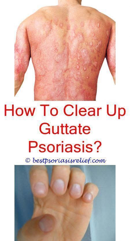Psoriasisonhands Pcos And Psoriasis Diet What Is Psoriasis Images