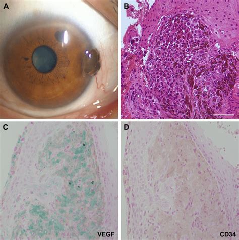 A Representative Case Of Conjunctival Melanoma In A 65 Year Old Female