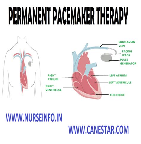 Permanent Pacemaker Implantation Nurse Info
