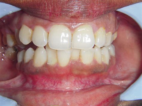 Treated Cases Scaling Restore Dental Treatment Centre Rajkot
