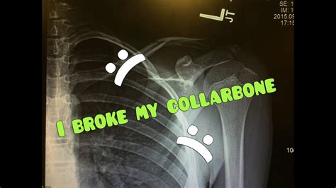 I Broke My Collarbone Youtube