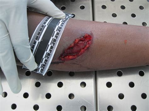 Wounds and Lacerations ~ With Info