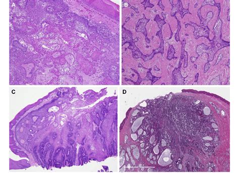Peripheral Ameloblastoma Histology