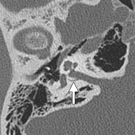 Lesions Of The Petrous Apex Classification And Findings At Ct And Mr