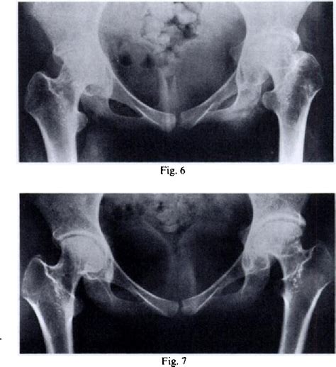 Figure 9 From Anteversion Of The Acetabular Cup Measurement Of Angle