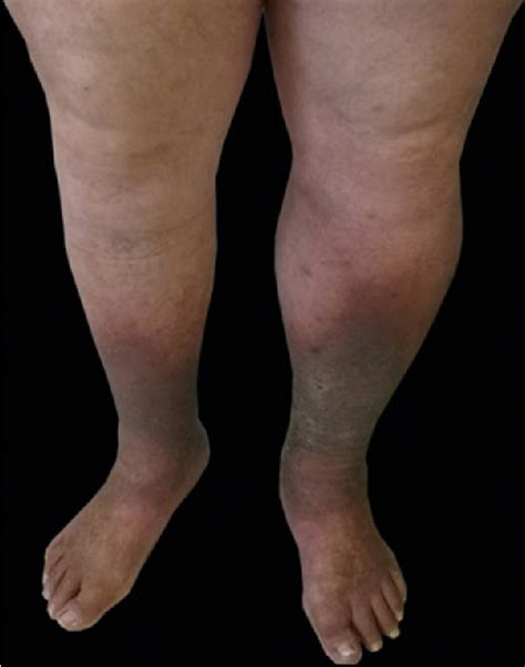 Brown Skin Discoloration On Lower Legs Dark Spots On Legs Diabetes