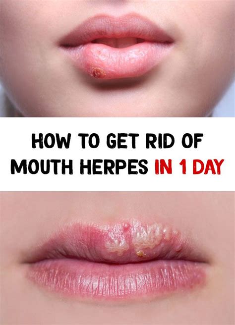 What Does Herpes Look Like On Lips What Does
