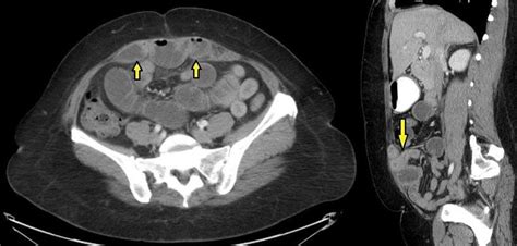 51 Year Old Female With A Posterior Rectus Sheath Hernia Findings