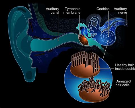 Tinnitus Active Life Hearing