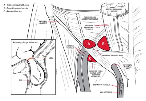 The groin is the area that lies between the abdomen stomach and thighs. Surgical Repair Of Reducible Inguinal Hernia - Carles Pen
