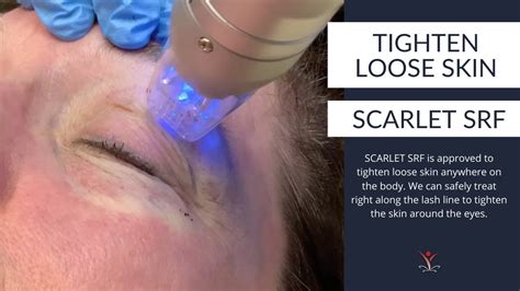 Tighten Eyelid Skin With Scarlet Srf Youtube