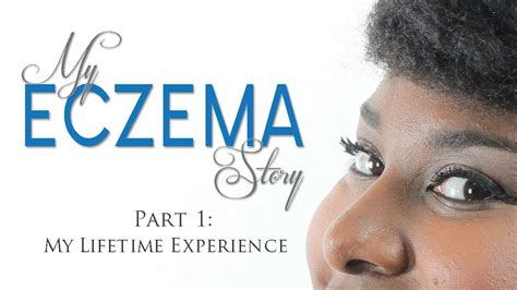 My Eczema Story Part 1 The Experience Mznaturallife Youtube