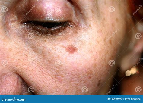 Pigmentation On The Face Brown Spot On Cheek Pigment Spot On The Skin