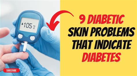 9 Diabetic Skin Problems That Indicate Diabetes In 2023 Youtube