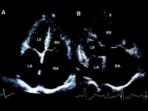 Clinical Context And Mechanism Of Functional Tricuspid Regurgitation In