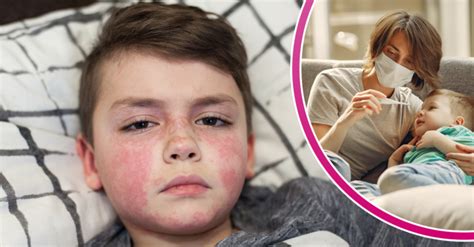 Scarlet Fever Symptoms Explained Amid Warning Of Rising Cases