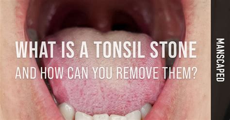 What Is A Tonsil Stone And How Can You Remove Them Manscapedcom
