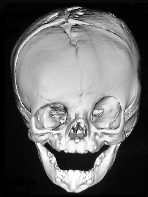 Unicoronal Craniosynostosis Neupsy Key