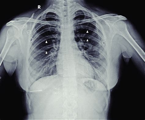 Chest X Ray Posteroanterior Pa View Of The Patient Shows Prominent